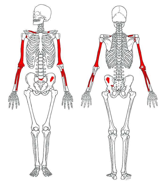 Representació dels elements postcranials conservats de KNM-ER 64061 en vistes anterior (esquerra) i posterior (dreta).