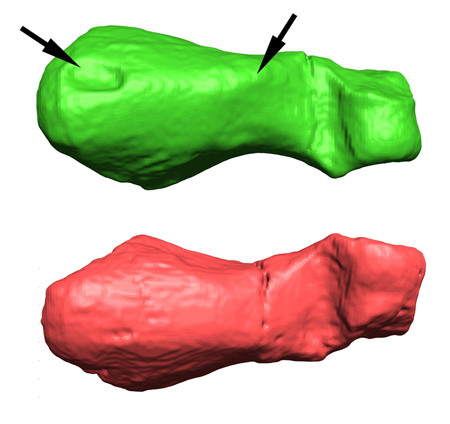 Imatge de Tomografia Computada (TC) d'una falange normal (vermell) i la falange amb osteitis proliferativa (verd)