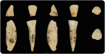 Les proteïnes en l’esmalt dental d’Homo antecessor il·luminen el camí del llinatge humà